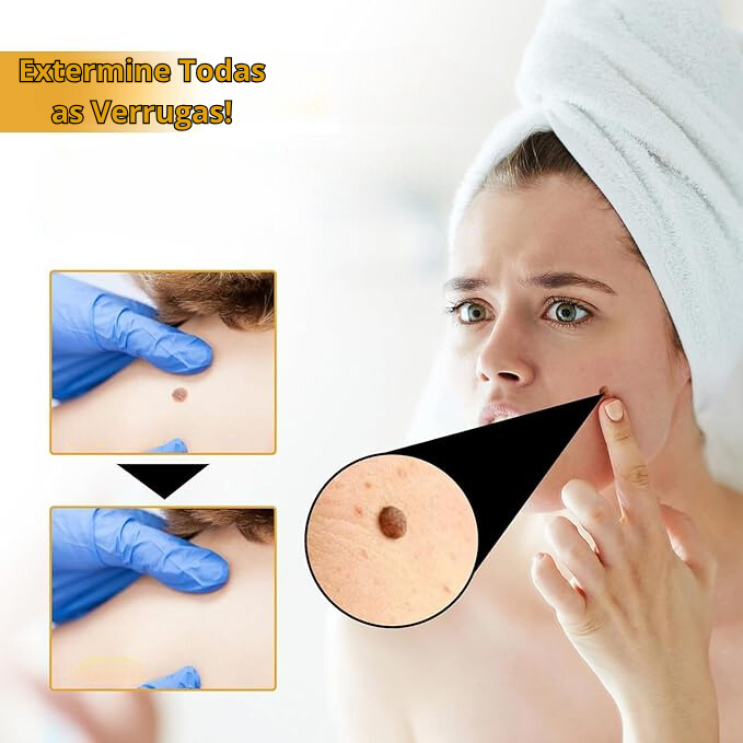Spray removedor de Verrugas - BeeClean