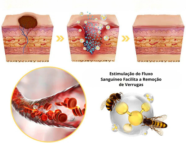 Spray removedor de Verrugas - BeeClean